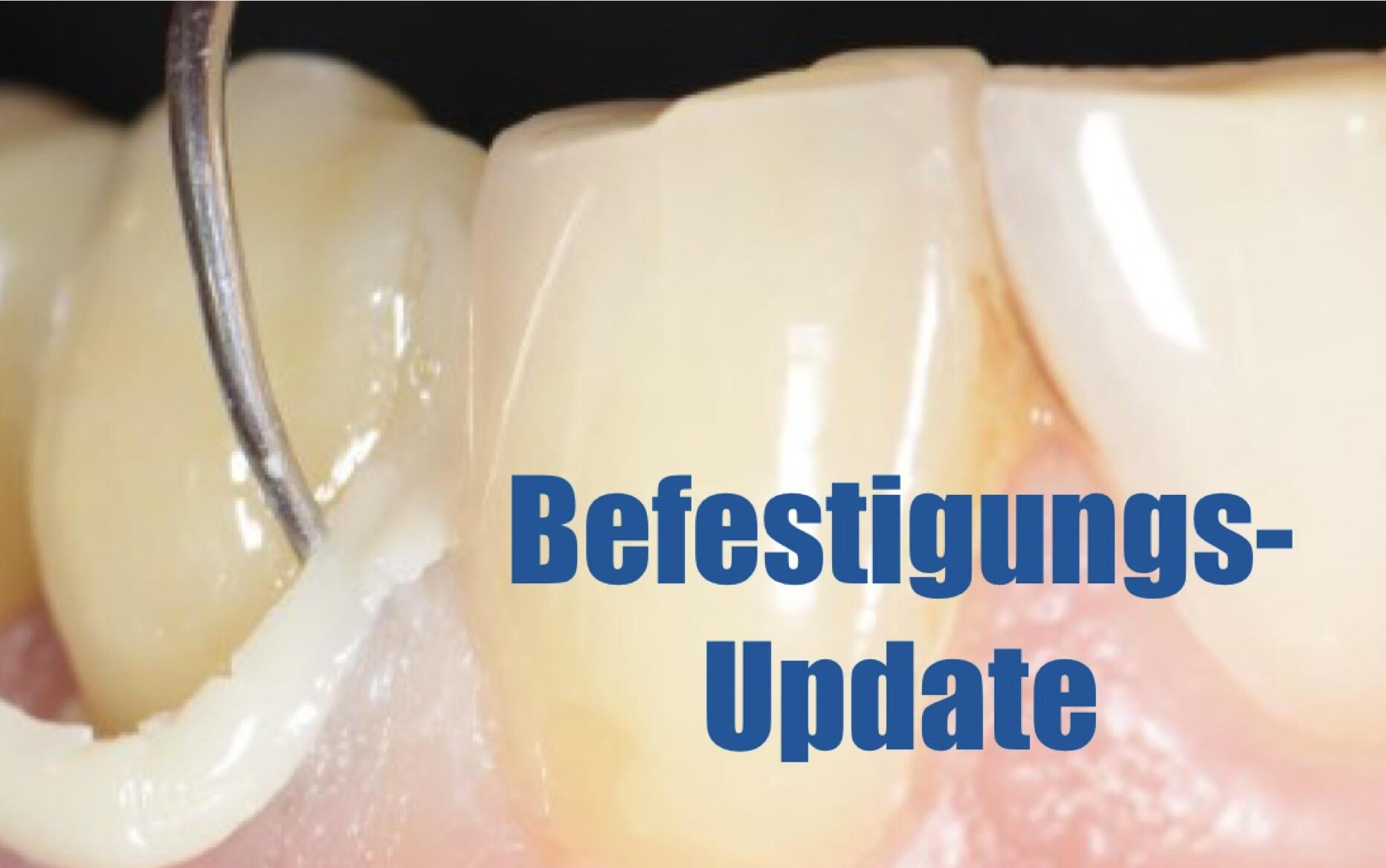 Das Befestigungs-Update mit Solventum