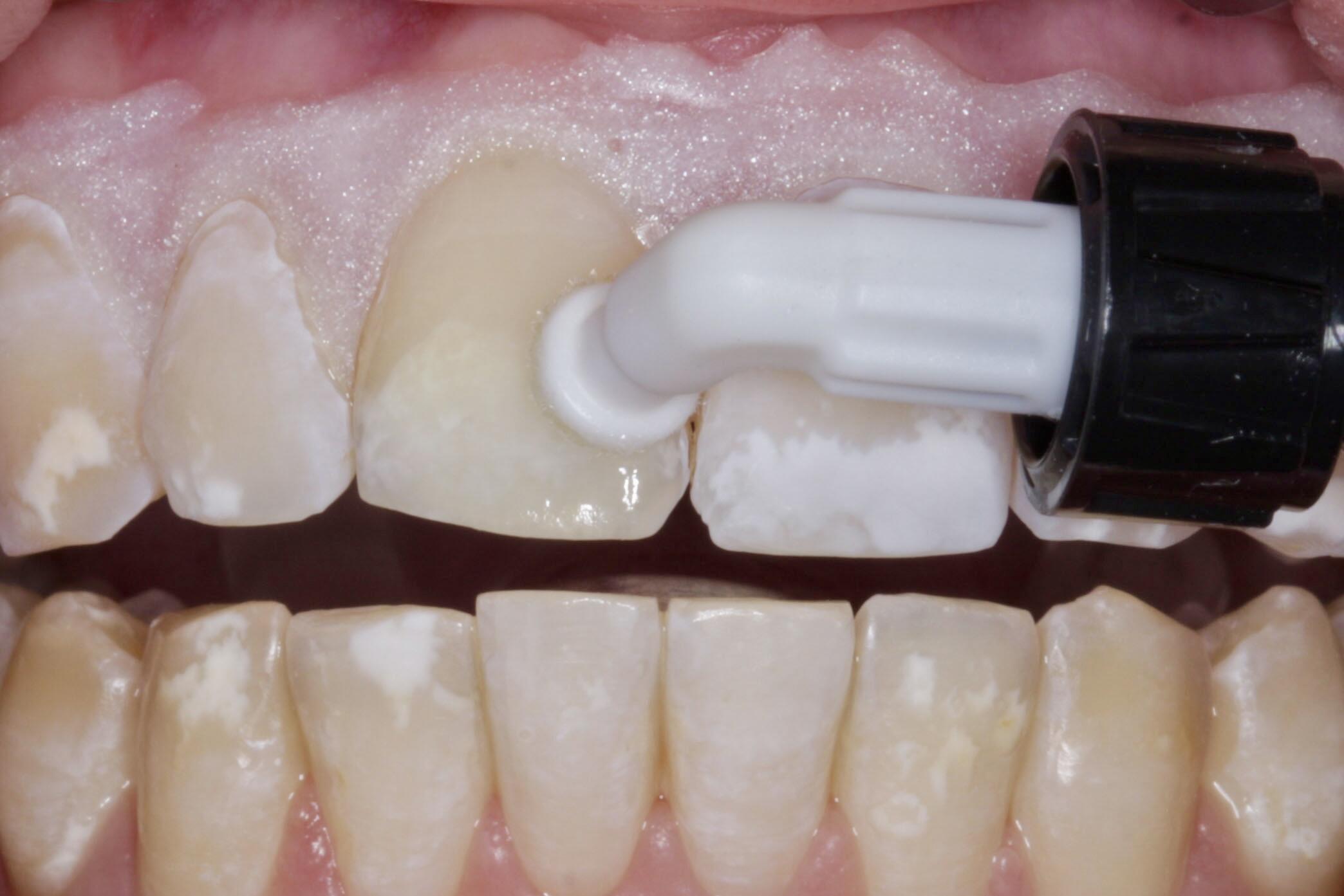  KUNSTSTOFFINFILTRATION - White Spots arretieren und maskieren