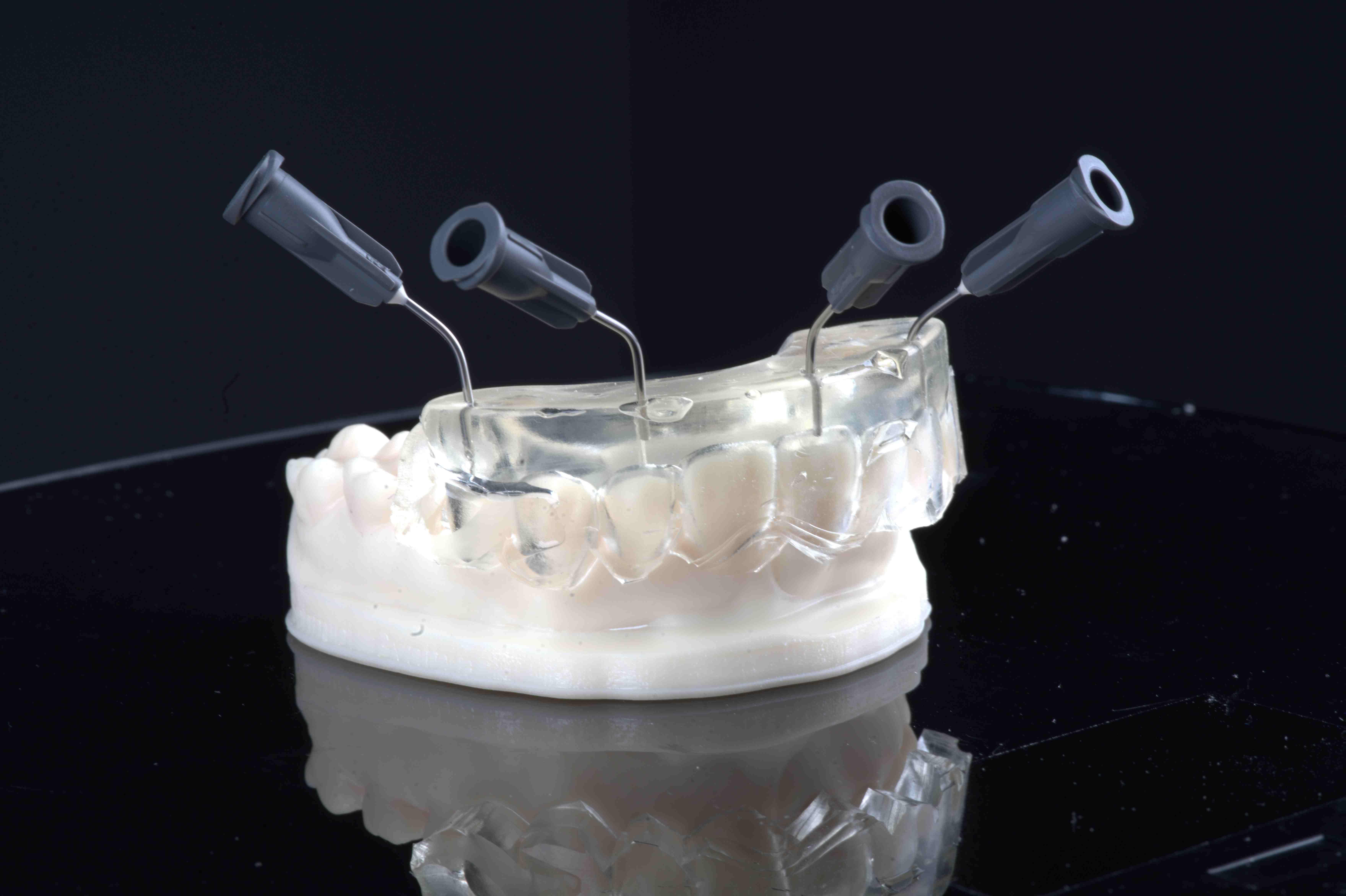 Injizieren statt Schichten – Ästhetische direkte Restaurationen mit der minimalinvasiven Injection Moulding Technik (IMT)